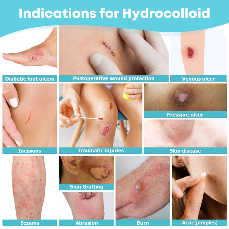 Hydrocolloid Roll for Wound Care
