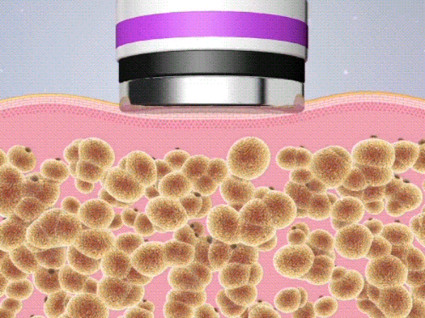 Anti-cellulite Cupping & Scraping Device