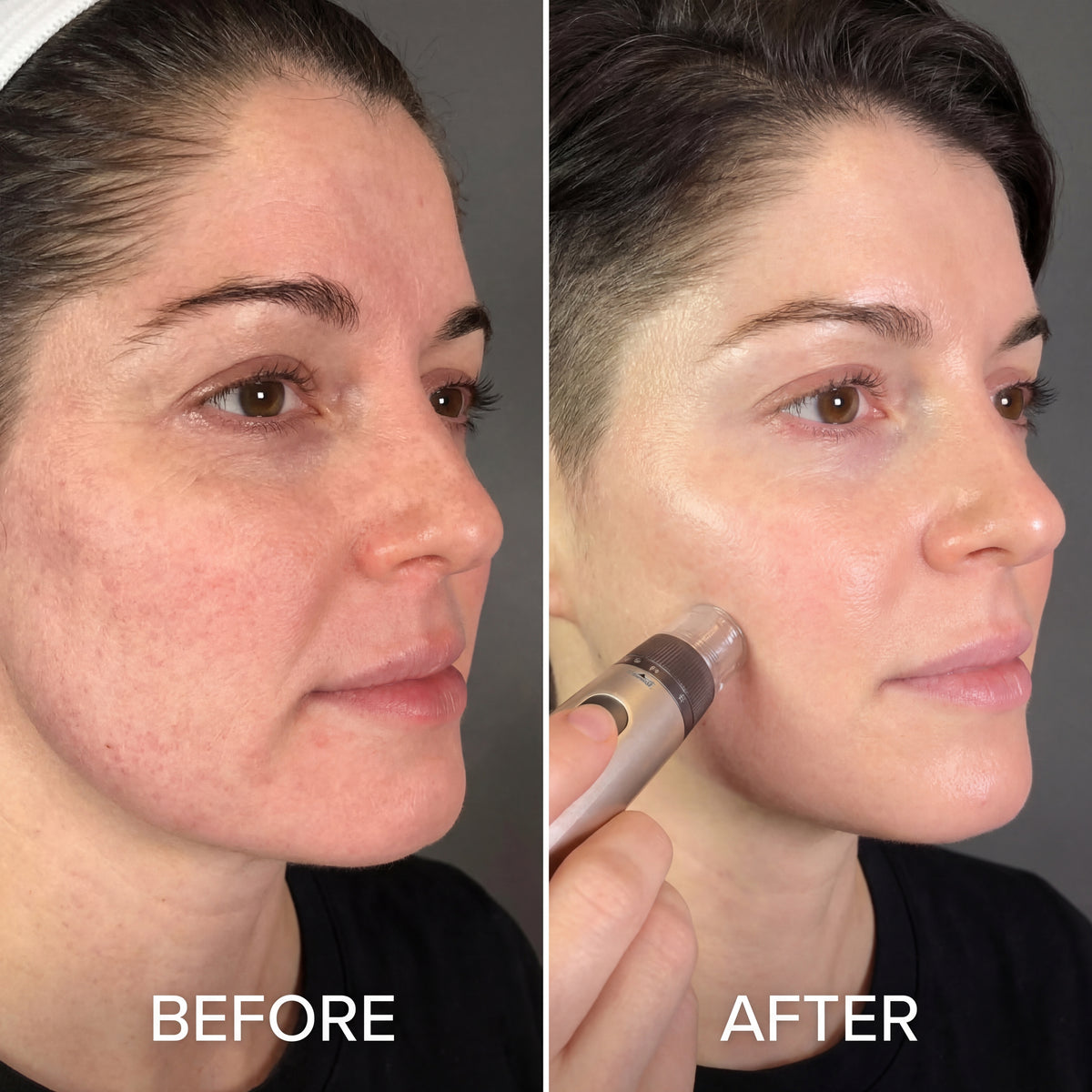 Hydra Pen H5 Professional Microneedling Pen